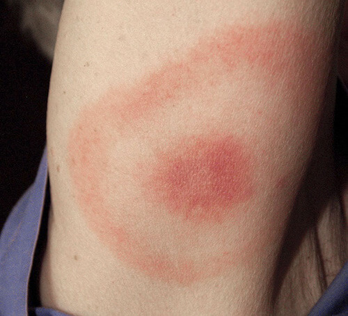 Erythema migrans